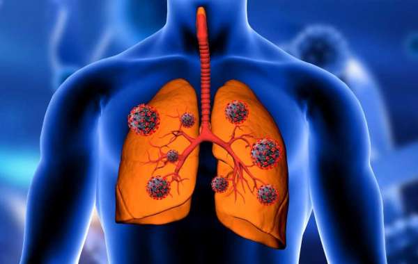 Extensive Stage Small Cell Lung Cancer Market Report - Focuses on Epidemiology, Product, and Region - BIS Research