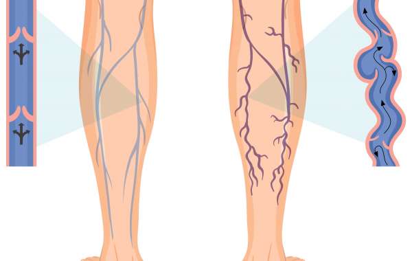 Deep Venous Disease Treatment Devices Market Insights, Trends, Growth Opportunities and Forecast to 2032