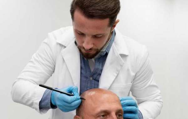 Affordable Hair Transplant Cost in California