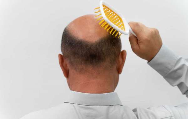 Say Goodbye to Baldness with Smart FUE Hair Transplants