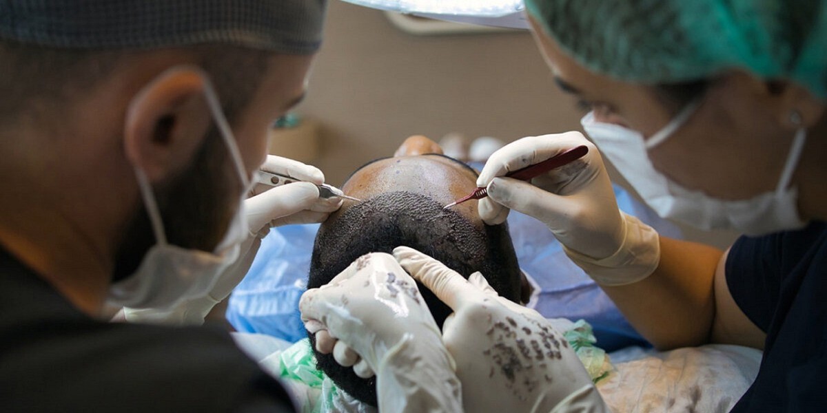FUT hair transplant results in Beverly Hills Hair Restoration