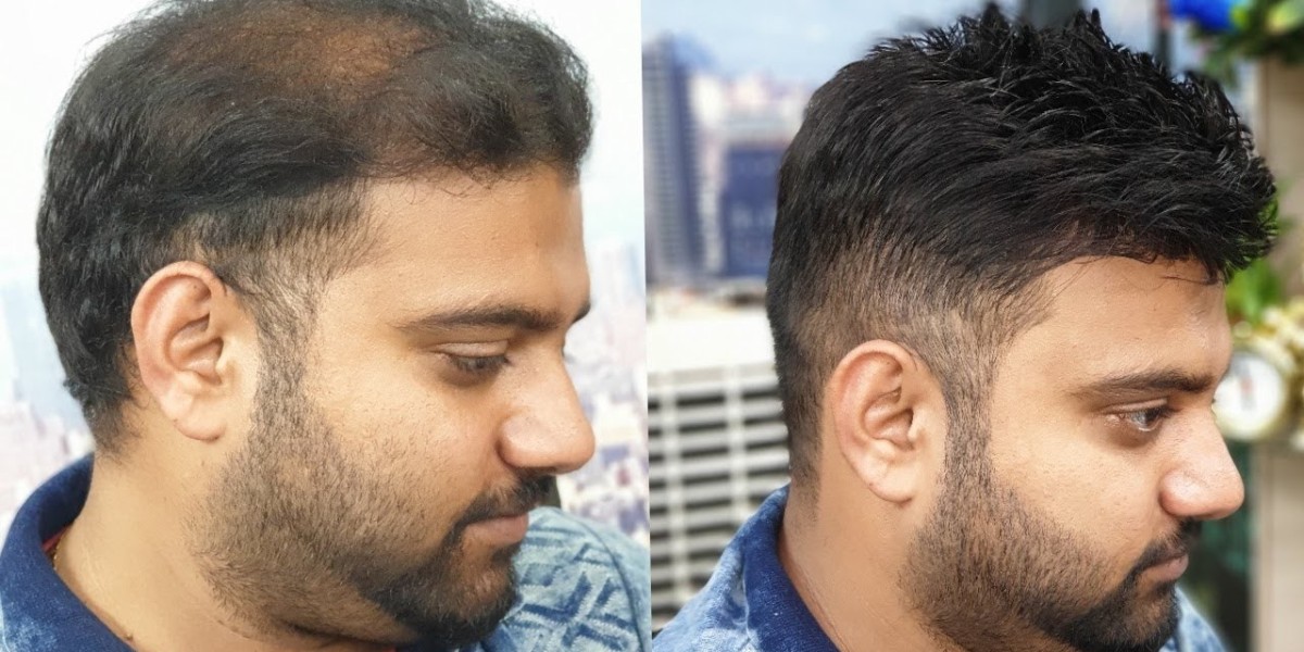 Hair Transplant in Pakistan: A Comprehensive Guide to Hair Restoration