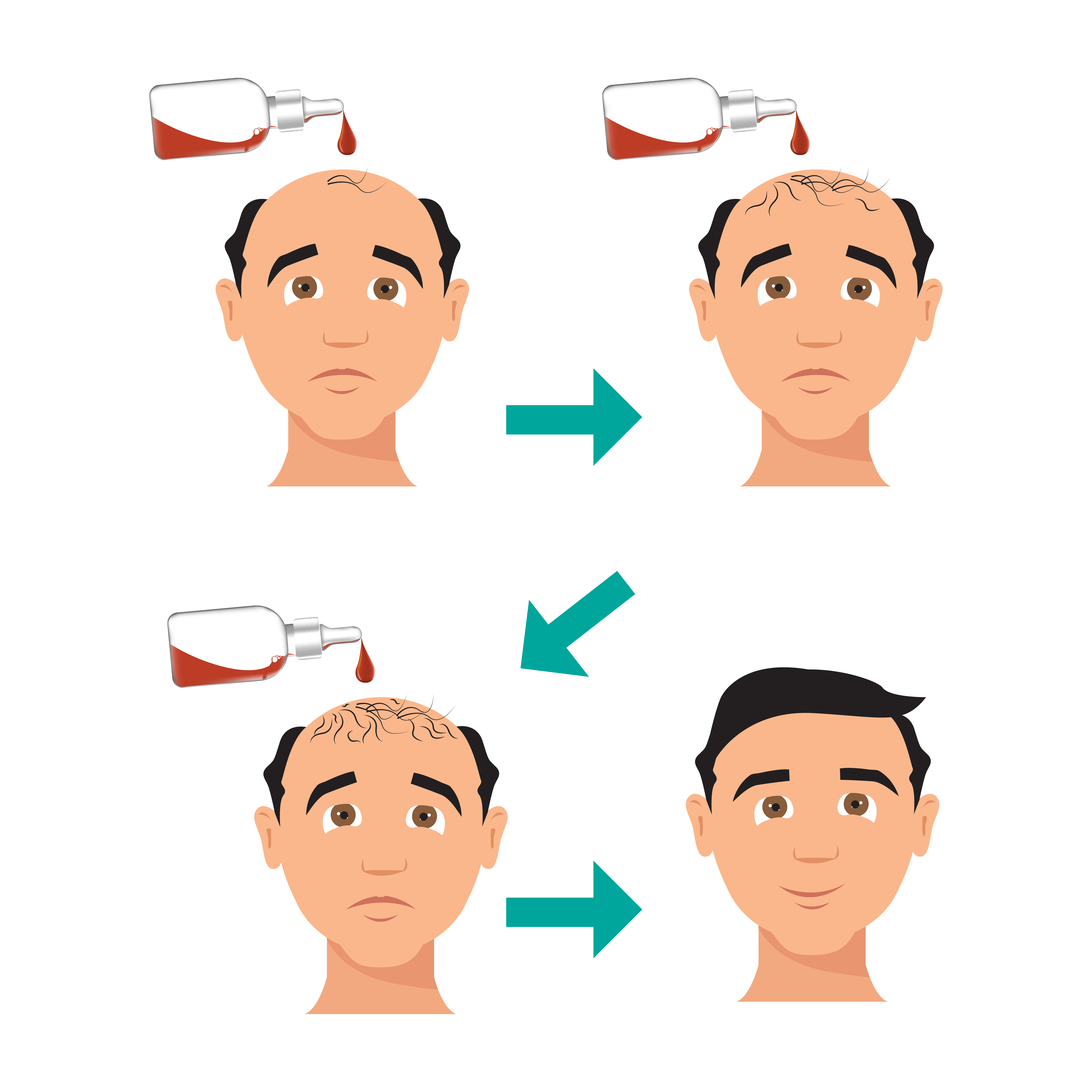 Hair Transplant in Sikar | Best Hair Restoration Clinic