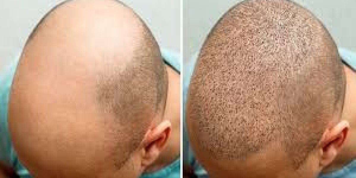 Hair Transplant Surgery