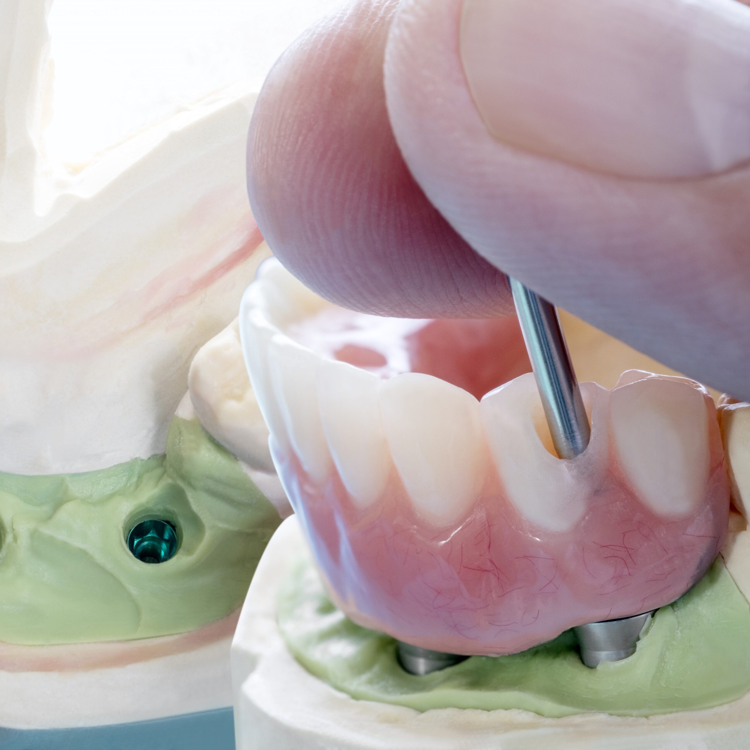 How Gum & Bone Quality Affects Dental Implant Success