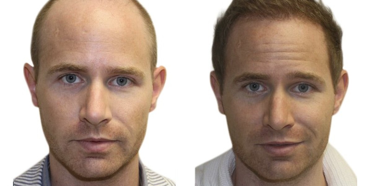 Finding the Best Hair Transplant Clinic in London