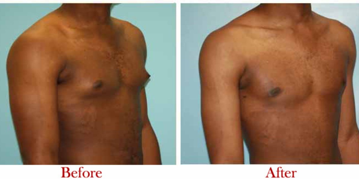 Best Gynecomastia Surgery in Delhi – Regain Your Confidence