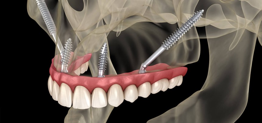 Blogs - Bang Box online - How Zygomatic Implants Provide a Solution for Severe Jawbone Loss