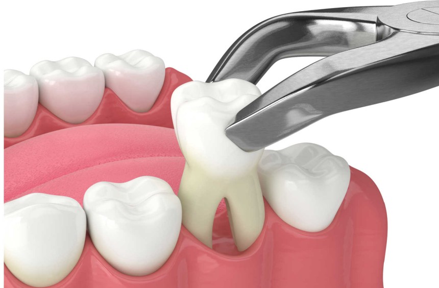 Blogs - Bang Box online - Wisdom Teeth Extraction: Is It Really Necessary?