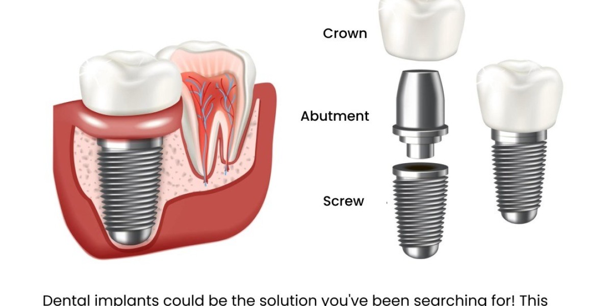 Affordable and High-Quality Dental Implants in Bangalore: What You Need to Know