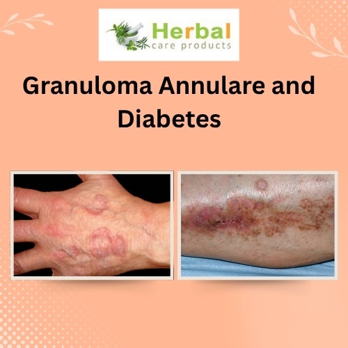 Granuloma Annulare and Diabetes: What You Need to Know About the Connection - Herbal Care Products - Blog