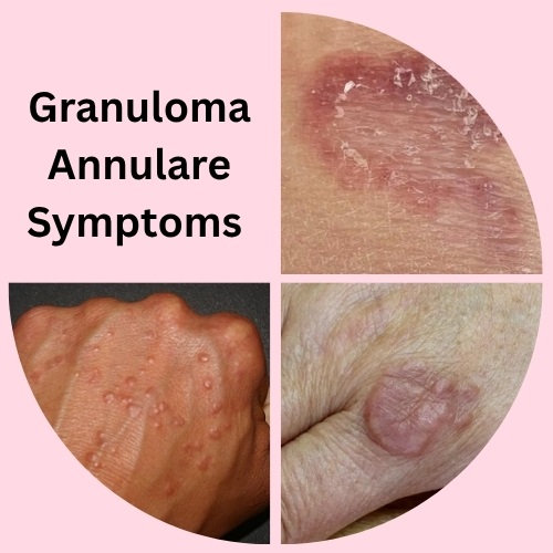 How to Spot Granuloma Annulare Symptoms Early: A Clear Patient Guide - Herbal Care Products - Blog