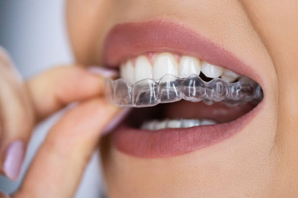 Smile Transformation Secrets: Why Clear Aligners Are Changing Orthodontic Care – Site Title